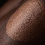 Beyond the Scar: Psychological Effects of Keloids in African Americans