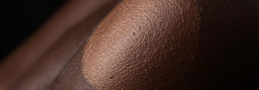 Close-up of a keloid scar on dark skin.